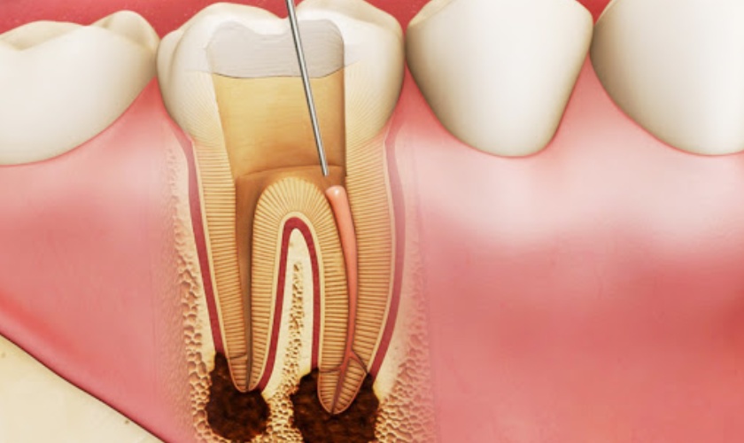 FAQ: Root canal treatment