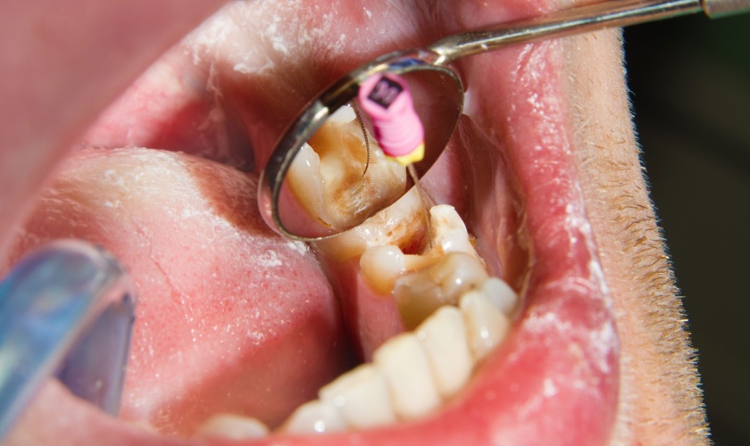 Root canal treatment