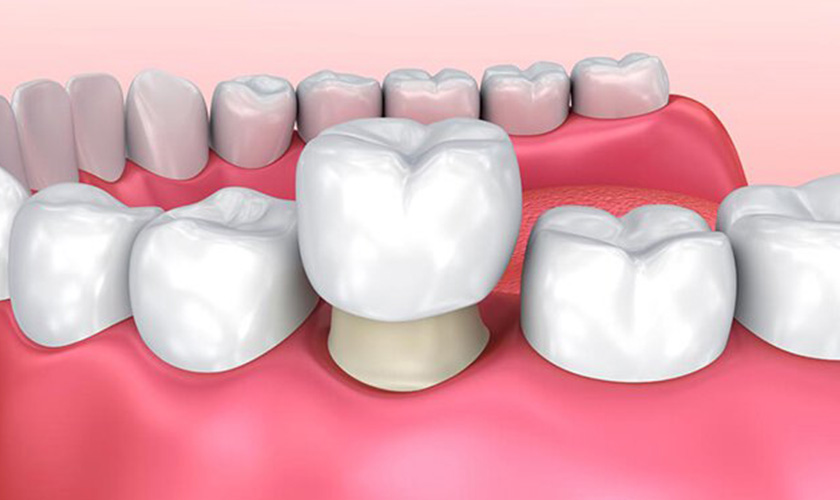 Root canal treatment