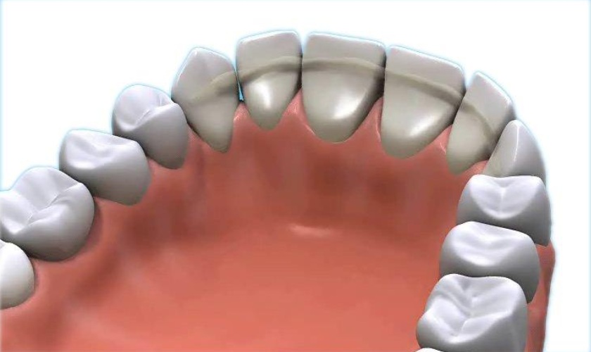 bonded fibreglass retainer