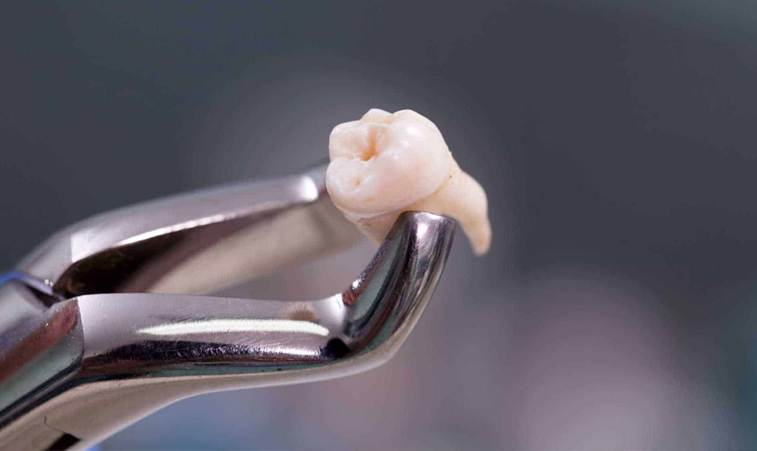 wisdom teeth