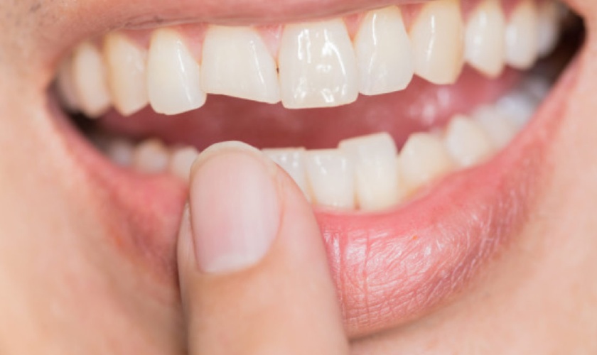 I have a broken and decay incisor. What should I do?