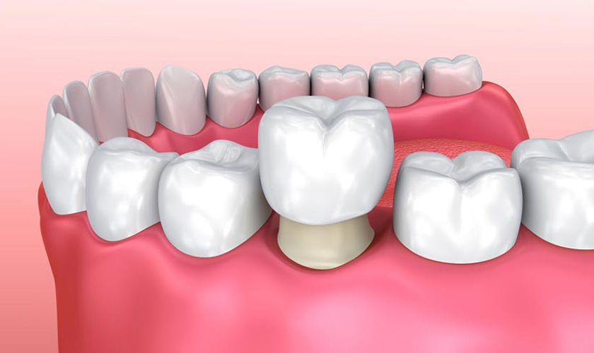 Simulate the method of porcelain crown