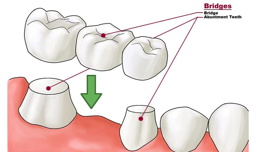 What are dental crowns?
