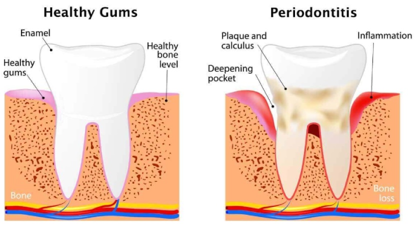 The phenomenon of toothache is often caused by periodontitis