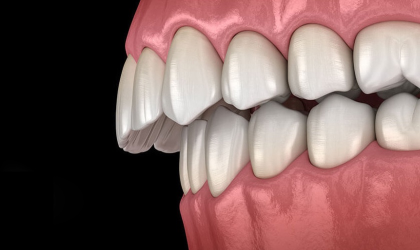 Protruding teeth seriously affect the aesthetic function and chewing