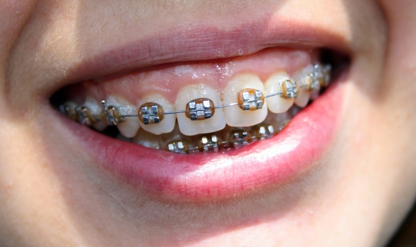 What is the best way to fix the overbite?