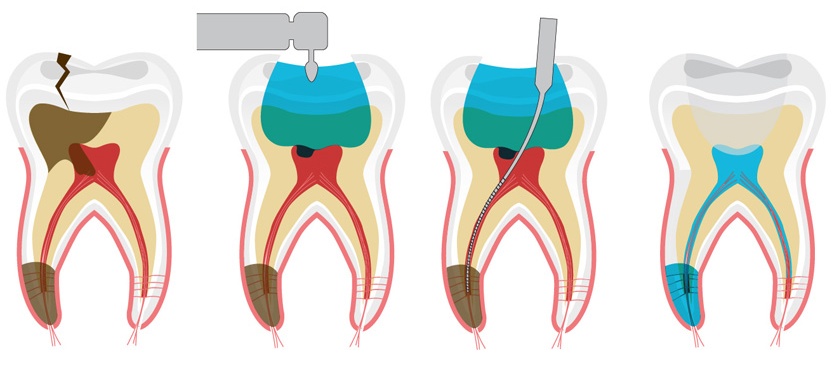 Avoid pulpal death during fixed prosthodontic procedures