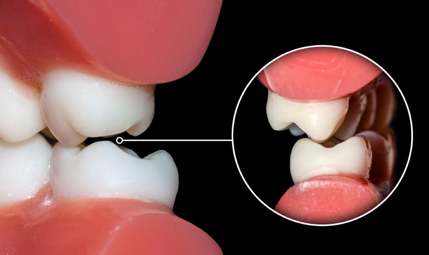 Avoid pulpal death during fixed prosthodontic procedures