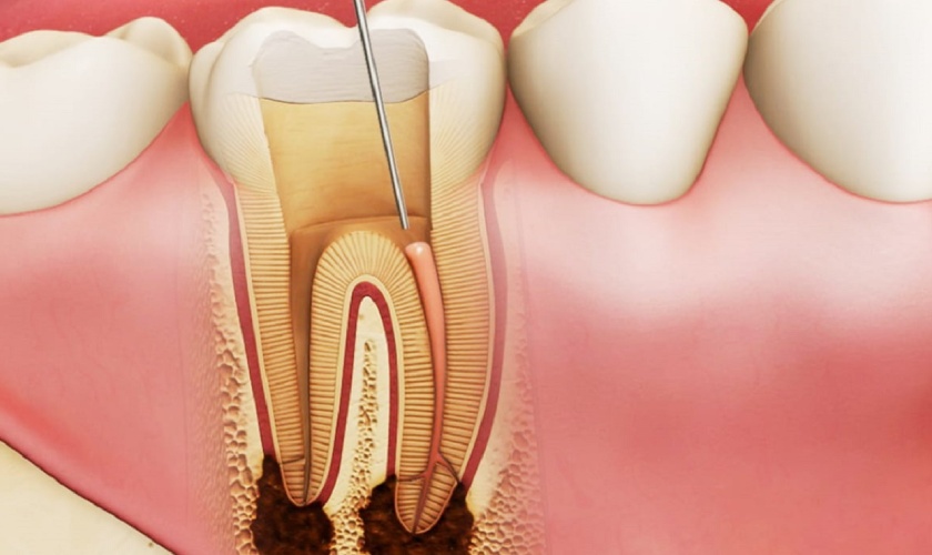 Avoid pulpal death during fixed prosthodontic procedures