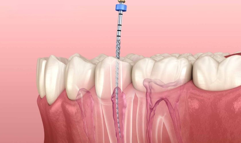 Dental pulpitis 