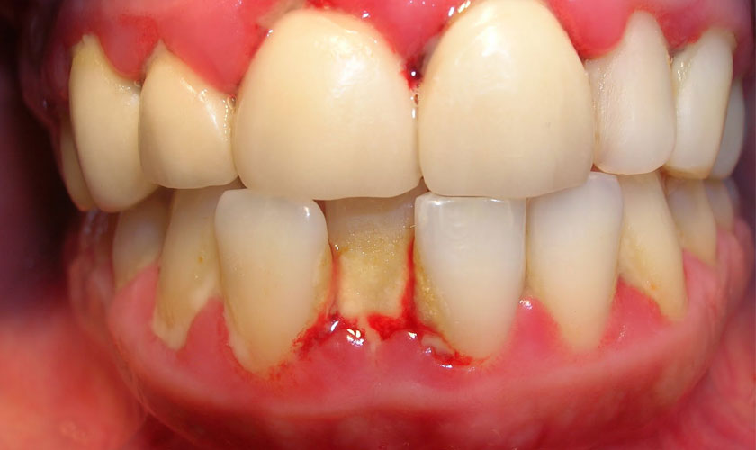 Periodontitis – Don't underestimate it