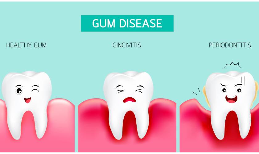 Gum disease treatment