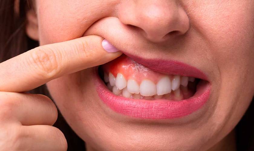 Overview of periodontal disease