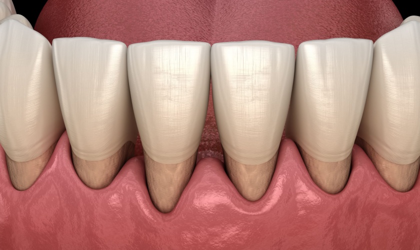 Periodontal disease and systemic disease