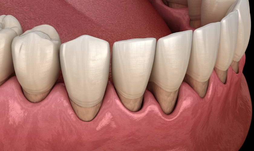 Periodontal Disease - Dangerous disease in dentistry
