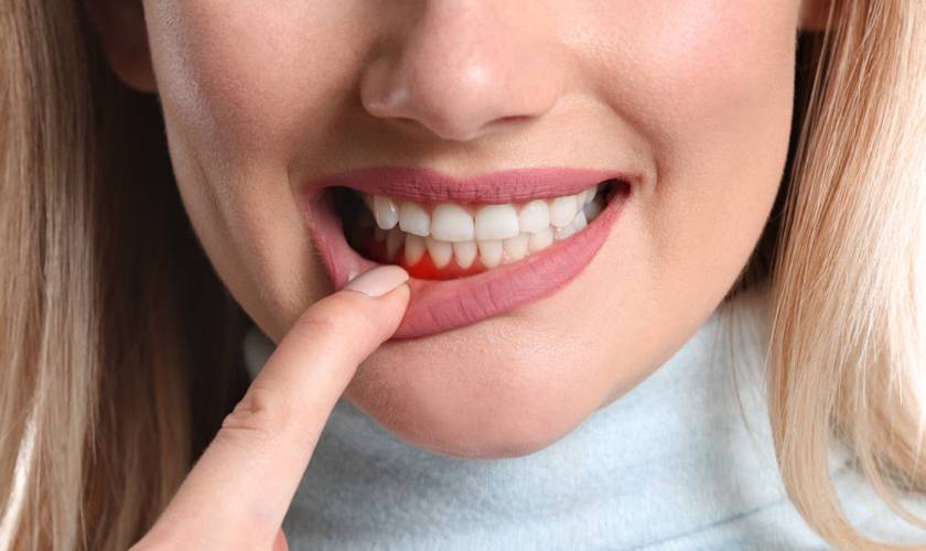 Periodontitis and treatment