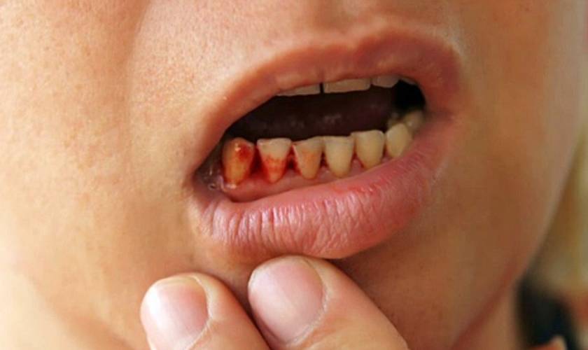 The signs and causes of gum disease