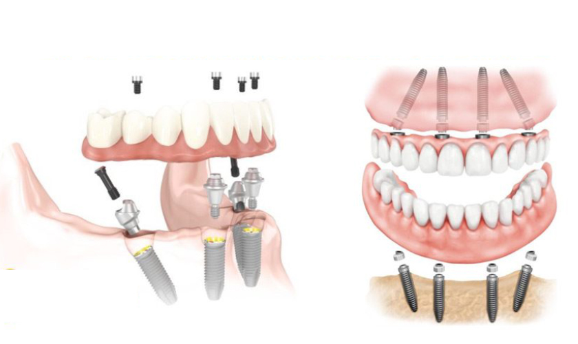 All on 4 dental implants - solution to restore the entire teeth