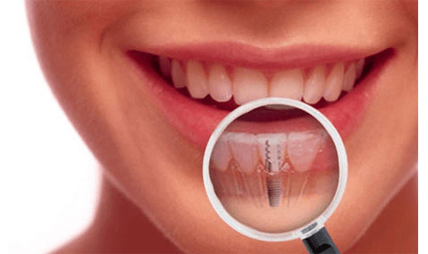 With dental implant navigation system, doctors can implement dental implant surgery right away without taking 1 week to make a surgical guide stent