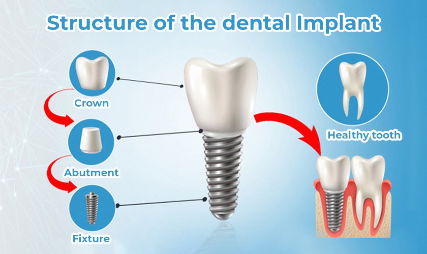 The price of implant teeth will be calculated based on the components that make up the implant teeth