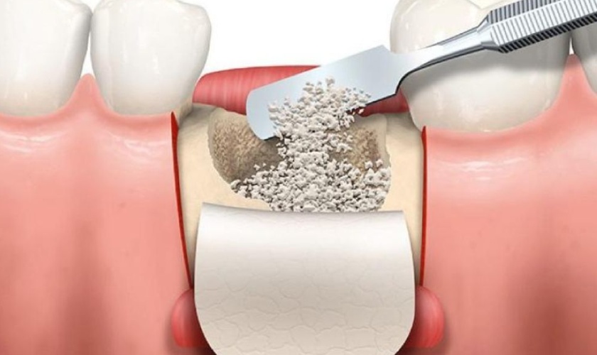Long-term tooth loss leading to jaw bone loss requires bone grafting