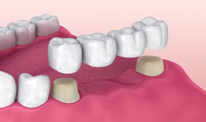 Porcelain bridges need to grind the teeth on both sides to make a pillar to support the bridge