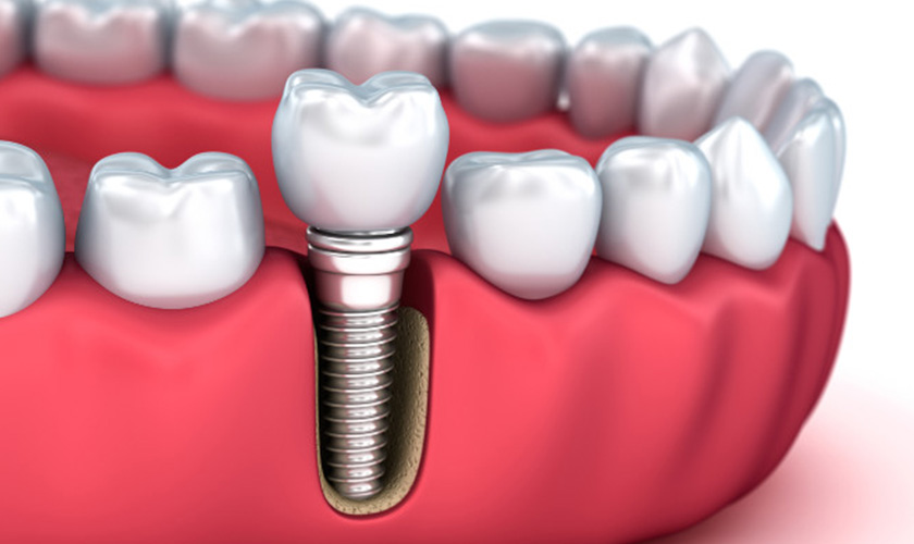 Dental implants are considered the most advanced solution to restore missing teeth today