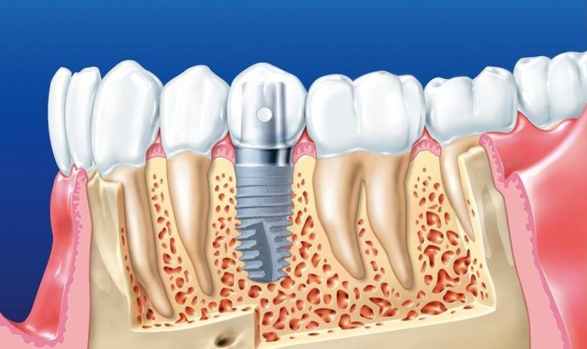 The price of an implant will depend on the type of fixture you choose
