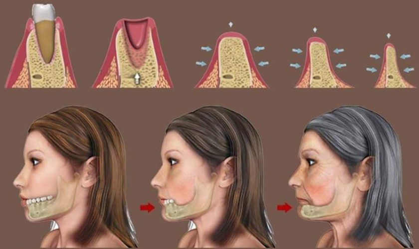 Implants help prevent osteolysis effectively