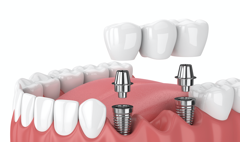 Dental implant navigation system brings a lot of benefits to patients