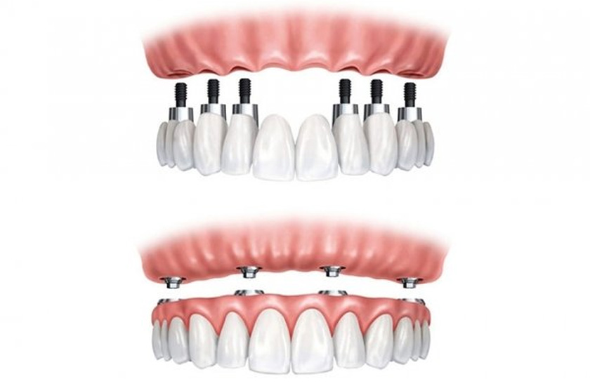 With dental implant