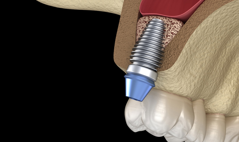 A maxillary sinus floor augmentation proceduce