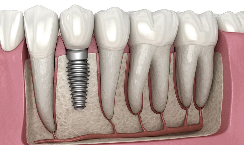 Advantages of dental implants over dentures or a bridge