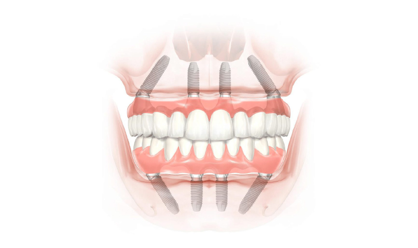 All on 4 dental implants