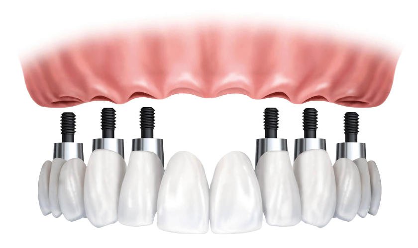 All on 6 dental implants
