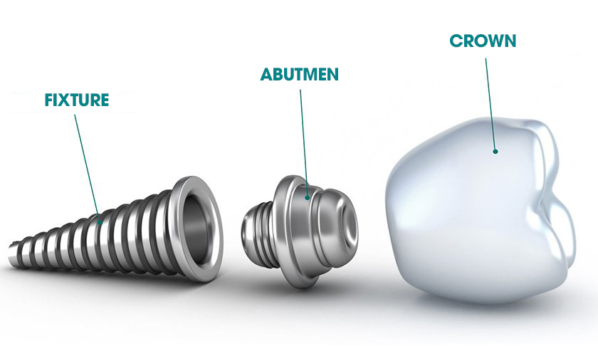 Cấu tạo 3 phần của răng Implant