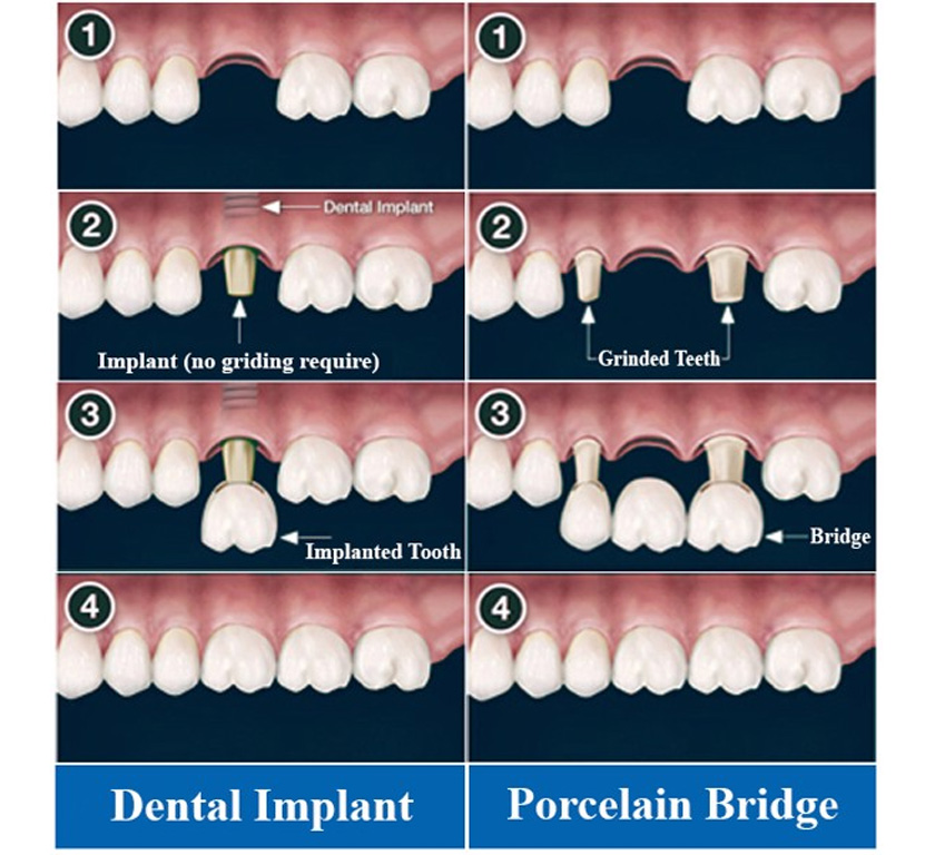 Comparison between dental implant and bridgework