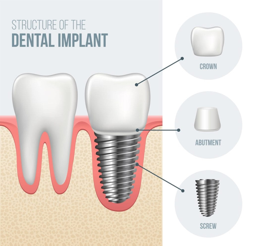 Implant structure
