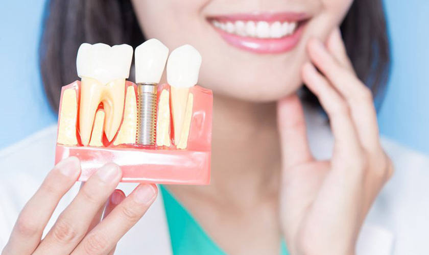 Răng implant có độ bền chắc lâu dài với thời gian