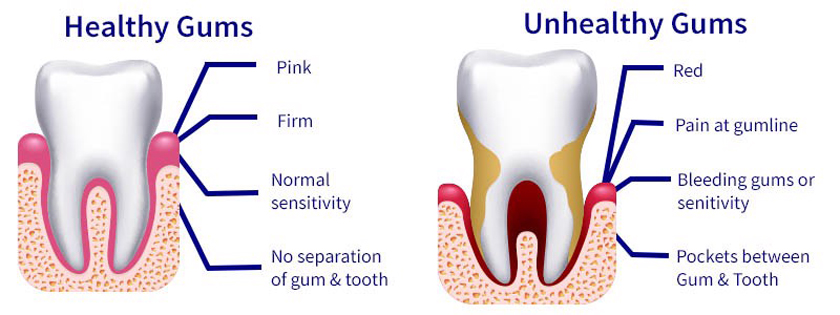 Cosmetic gum surgery for dental implant