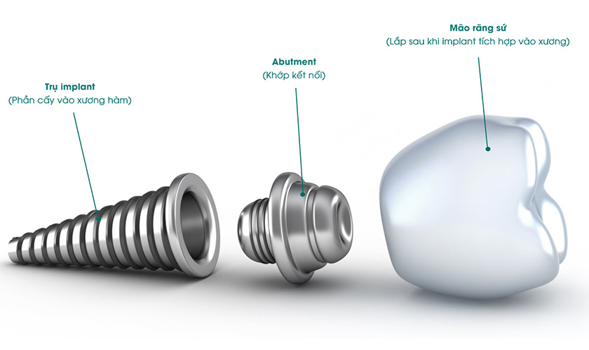 Cấu tạo của một răng implant Cấu tạo của một răng implant