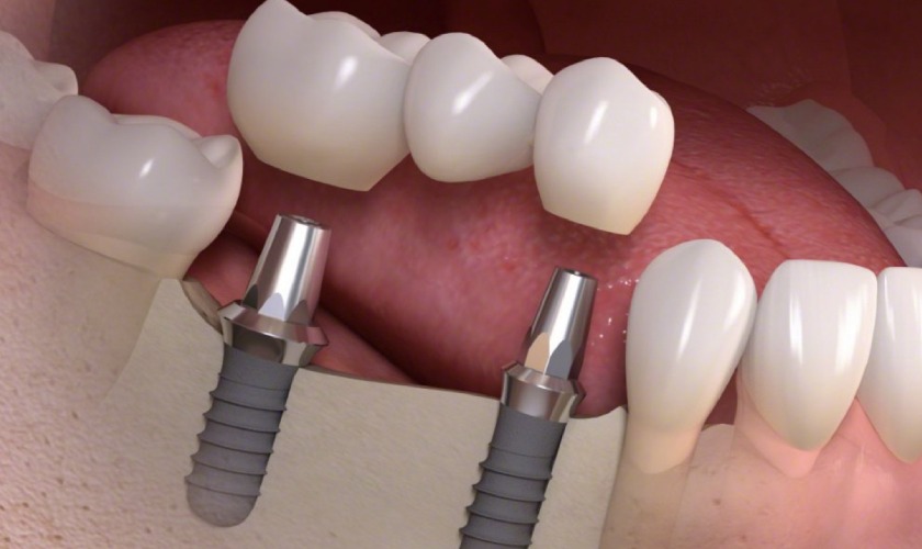 Porcelain dental bridge on implant Porcelain dental bridge on implant