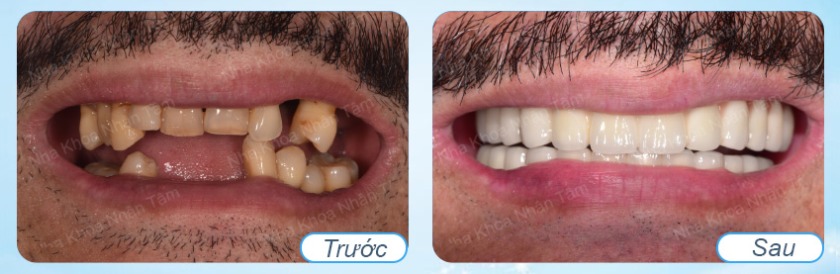 Hình trước và sau mất nhiều răng liền kề Hình trước và sau mất nhiều răng liền kề