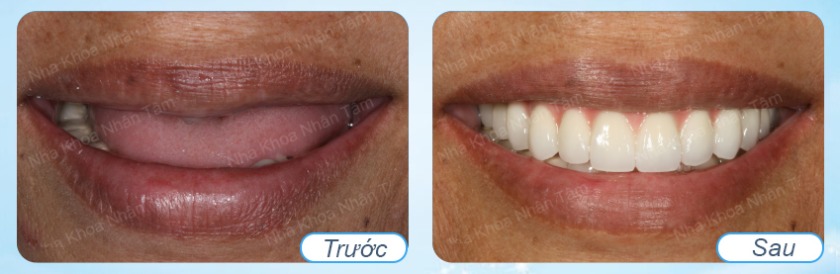 Hình trước và sau trồng răng implant hàm trên Hình trước và sau trồng răng implant hàm trên