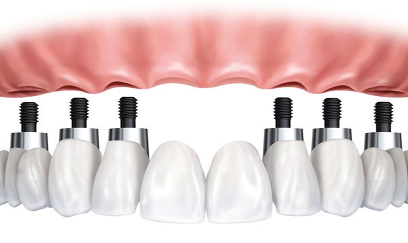 Hình: Dental Implant and problems to be avoided