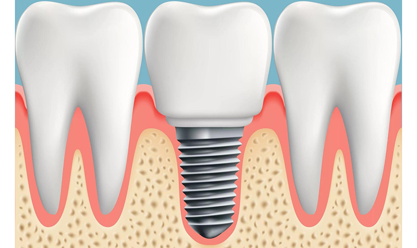 Dental implant - Have a teeth to eat in one to three weeks at Nhan Tam Dental