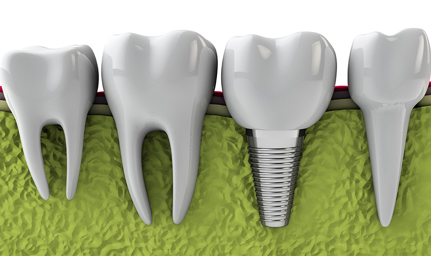 Dental implant history
