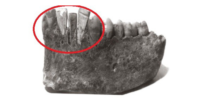 Document proves the ancient know how to grow dentures