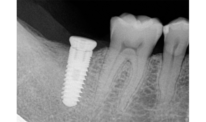 The first implant implant in Vietnam still works well
